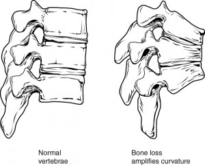 Osteoprosisof Spine en.wikipedia.org