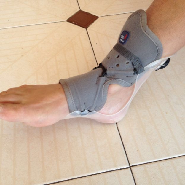 Pie equino qué es y cómo se trata El blog definitivo de Ortopedia